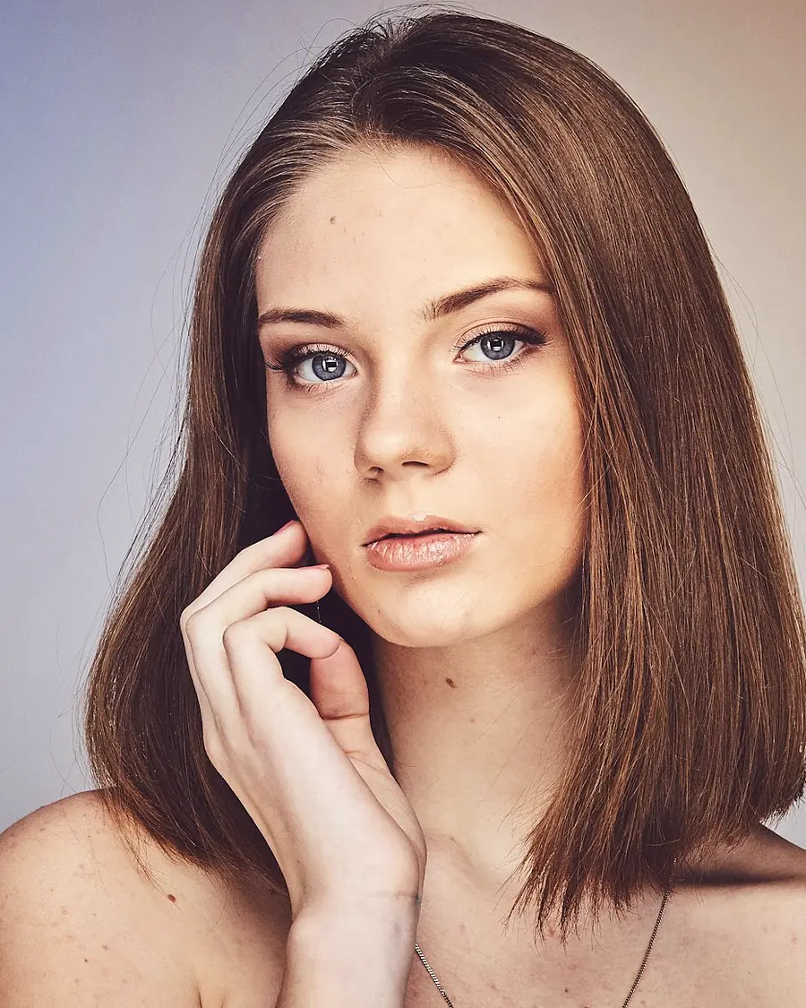 After result — Precision Fractional Laser Resurfacing, illustrative comparison